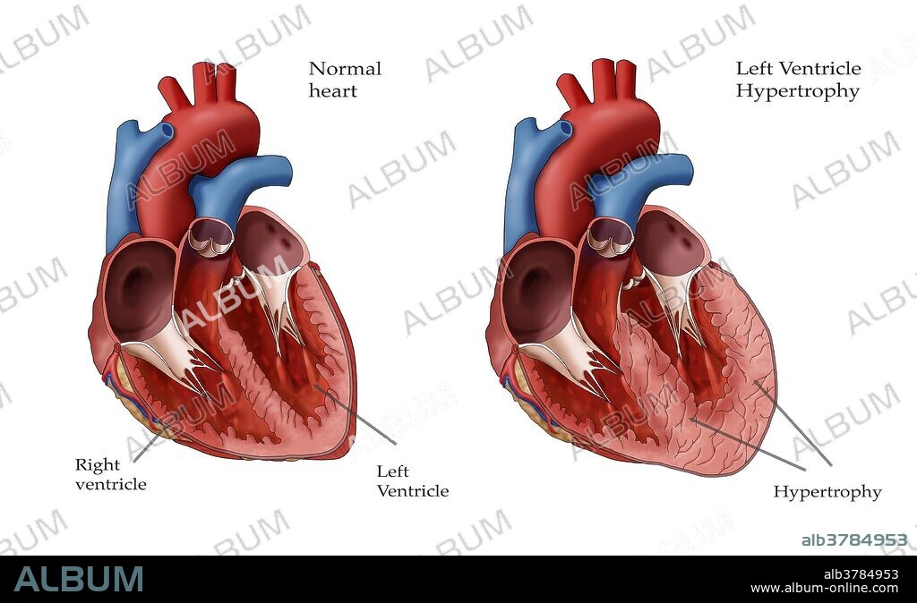 Illustration showing a normal heart at left and a heart with left ventricle hypertrophy at right. Left ventricle hypertrophy (LHV) can develop in response to factors such as high blood pressure which require the left ventricle to work harder. As the workload increases, the walls of the chamber grow thicker, lose elasticity and eventually may fail to pump as efficiently as a healthy heart.