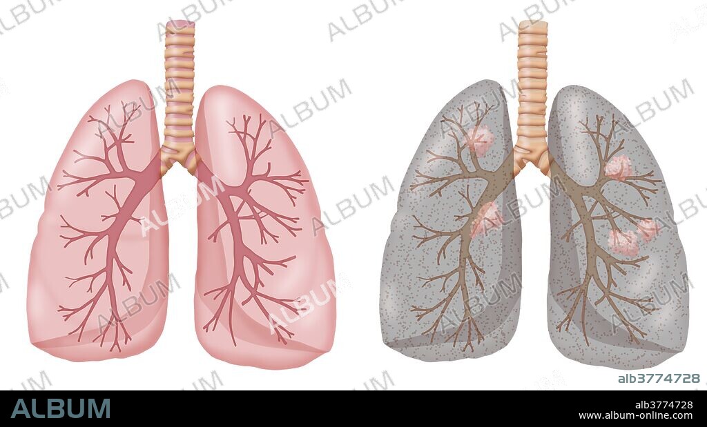 Illustration comparing the lungs of a non-smoker (left) and a smoker (right). The non-smoker's lungs are pink and healthy, whereas the smoker's are gray and filled with harmful particles. Lung cancer can also result from smoking; in this illustration tumors have developed.