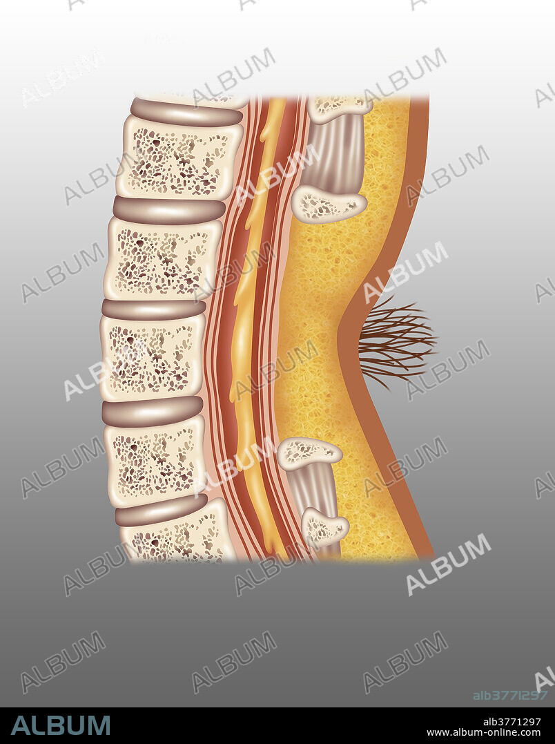 Illustration of spina bifida occulta. Spina bifida occulta is the mildest form of spina bifida in which the outer layer part of vertebrae is not completely closed. The skin may have a dimple or hair growth at the lesion site.