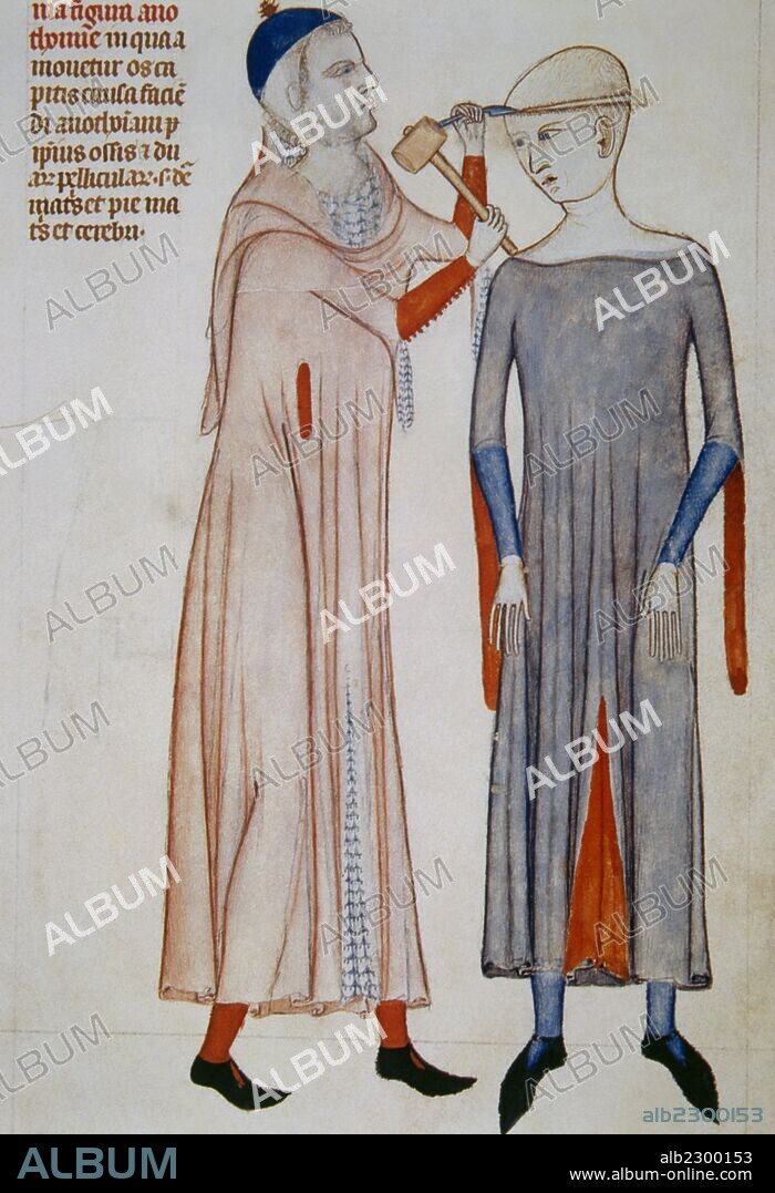 Illustration of trepanation. Miniature. 14th century. Treatise on anatomy by Mondino de Liuzzi (1270-1326). Italian anatomist nad profesor of Bologna.