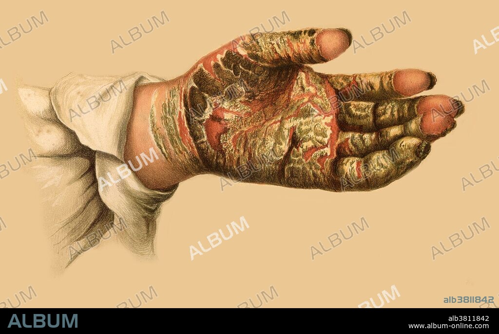 This image shows a hand infected with Scabies Norvegica (Crustosa). Scabies is a contagious skin infection caused by the mite Sarcoptes scabiei burrowing into the skin and laying its eggs. Often this causes itching and the urge to scratch leads to broken and then infected skin. Scabies Norvegica is a highly contagious form of the infection often affecting the immunosuppressed such as those with HIV and AIDS. When infection occurs this can cause inflammation and swelling or edema. Chromolithograph, 1878-1888. Illustration by E. Burgess after R. W. Sherwin, Mabel Green and Jonathan Hutchinson.