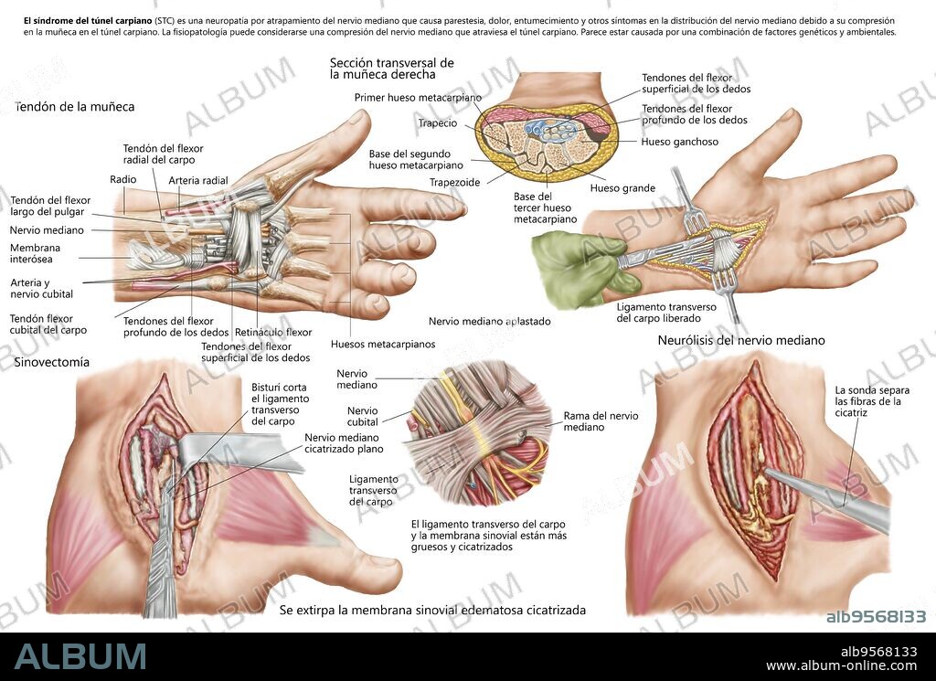 Medical illustration showing carpal tunnel syndrome in the human wrist, and the surgical procedures associated with it.