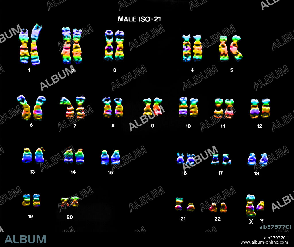 Colour enhanced micrograph of a karyotype showing an isochromosome in pair 21. An isochromosome is a chromosome that has lost one of it's arms and replaced it with a copy from it's other arm.