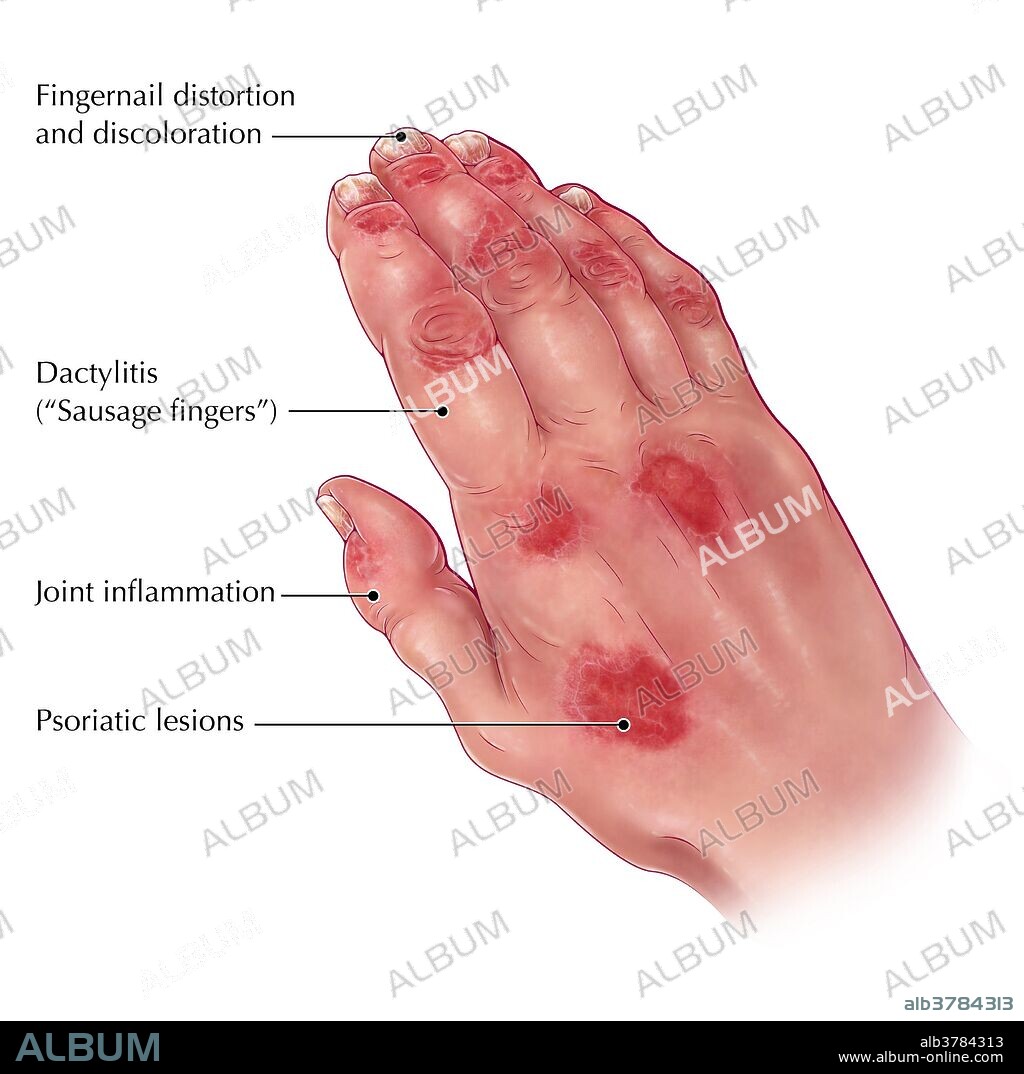 An illustration of psoriatic arthritis, a chronic skin condition (psoriasis) accompanied by arthritis and other joint problems. Aside from the appearance of red skin lesions and joint inflammation, changes in finger nails and dactylitis (swelling of fingers that create a sausage-like appearance) are characteristic of psoriatic arthritis.