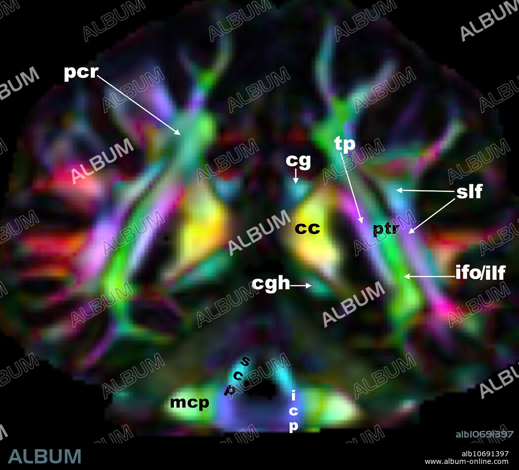 White matter brain tracts, DTI