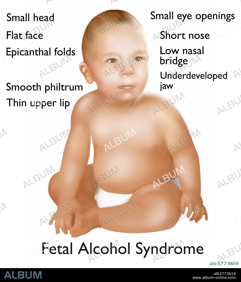 Foetal alcohol syndrome baby. Artwork with labels illustrating the facial features of a baby with foetal alcohol syndrome (FAS). This is a condition in infants that is caused by alcohol consumption by the mother when pregnant. Mental and physical defects such as a small head, flat face, epicanthal folds (inner eyelid fold), smooth philtrum (central groove in upper lip), thin upper lip, small eye openings, short nose, low nasal bridge (bony upper part of nose), and underdeveloped jaw, are common symptoms of this condition.