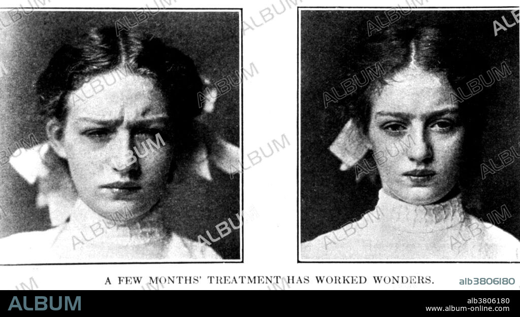 Two views of a female trachoma patient after treatment: on left is depiction of early stages of improvement characterized by ability to open eyes, on right she has her eyes wide open. Trachoma is a chronic contagious disease of the eye characterized by inflammation of the conjunctiva and cornea and the formation of scar tissue, caused by infection with the bacterium Chlamydia trachomatis. Pannus is an abnormal vascular thickening of the cornea. It occurs most often in conjunction with trachoma. Keratitis is an inflammation of the cornea.