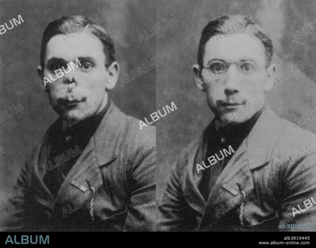 After the First World War, American sculptor Anna Coleman Ladd (1878-1939) ran the Studio for Portrait Masks in Paris, administered by the American Red Cross. With her four assistants, she made lifelike masks for disfigured French soldiers. Her workroom photographs document the "before and after" faces of each disfigured (left) and masked (right) soldier. After the patient's injury and/or restorative surgeries had healed, Ladd would take a plaster cast of his face. A mask was then crafted out of paper-thin galvanized copper and carefully painted to match skin color. Some even had real-hair mustaches. Every mask took at least month to make. Neither function nor mobile expression could be restored, of course, but after their "plastic surgery," the grateful soldiers were able to return to their families and rejoin society without being shunned. In 1932, Ladd was made a Chevalier of the French Legion of Honor.