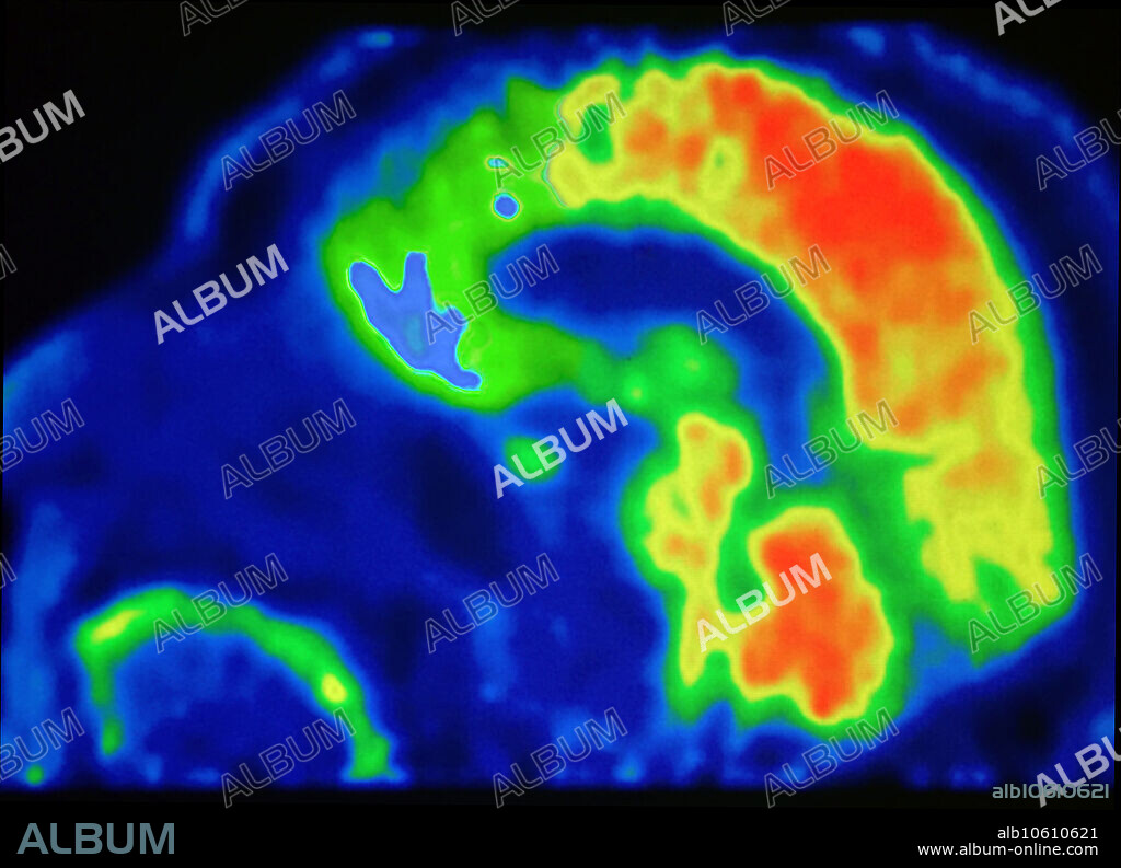 Sagittal PET Brain scan with F18 FDG reveals decreased metabolic activity in the frontal orbital cortex, which is associated with imbalance in behaviour seen with psychopaths and may be related to inability to suppress the amygdala, which is involved with aggression and appetites, ethical behaviour, moral decision-making and impulse control. There is normal activity elsewhere in the brain.