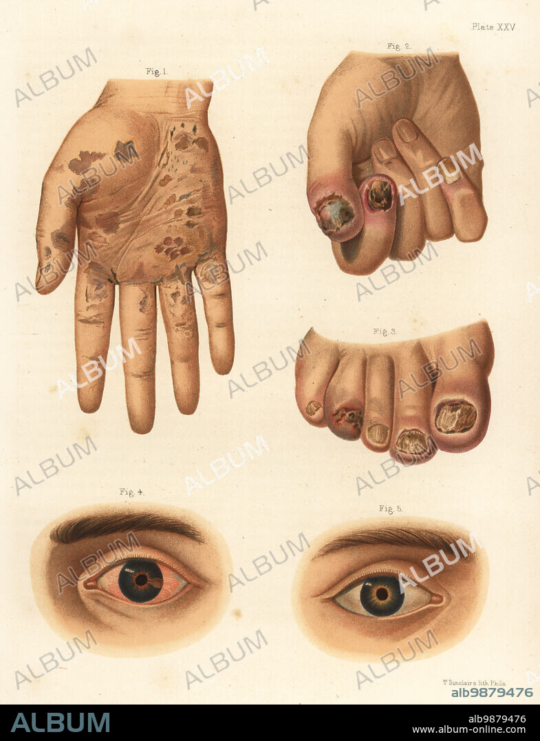 Secondary period syphilis symptoms on the body. Squamous syphilide on the hand 1, onychia of the finger and thumb 2, onychia of the foot 3, iritis of the eye 4,5. Chromolithograph by T. Sinclaire from Freeman J. Bumsteads Atlas of Venereal Diseases, Henry C. Lea, Philadelphia, 1868. First American edition of Auguste Culleriers Precis iconographique des maladies veneriennes.