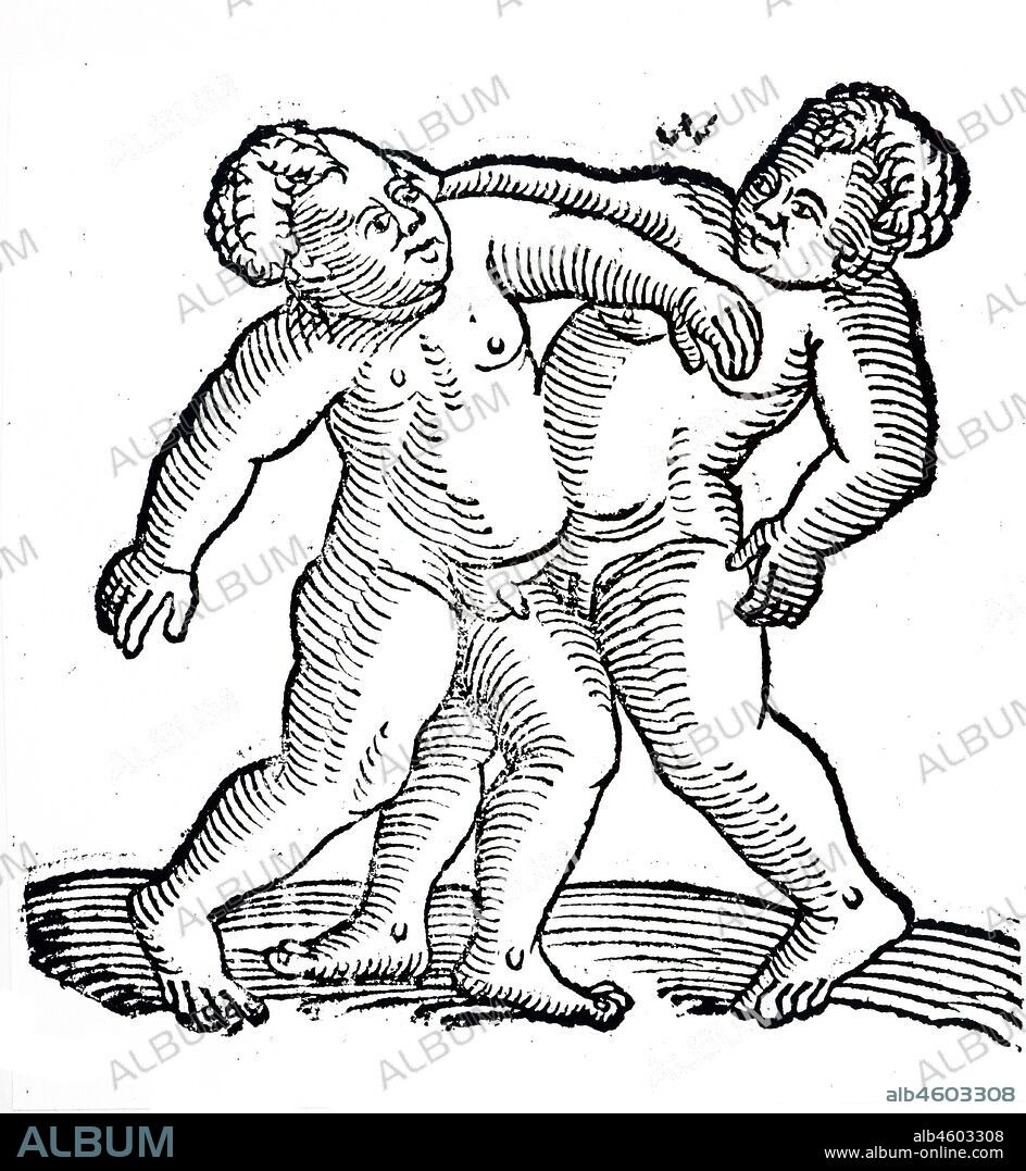 A woodcut engraving depicting Siamese twins, one boy and one girl. Dated 16th century.