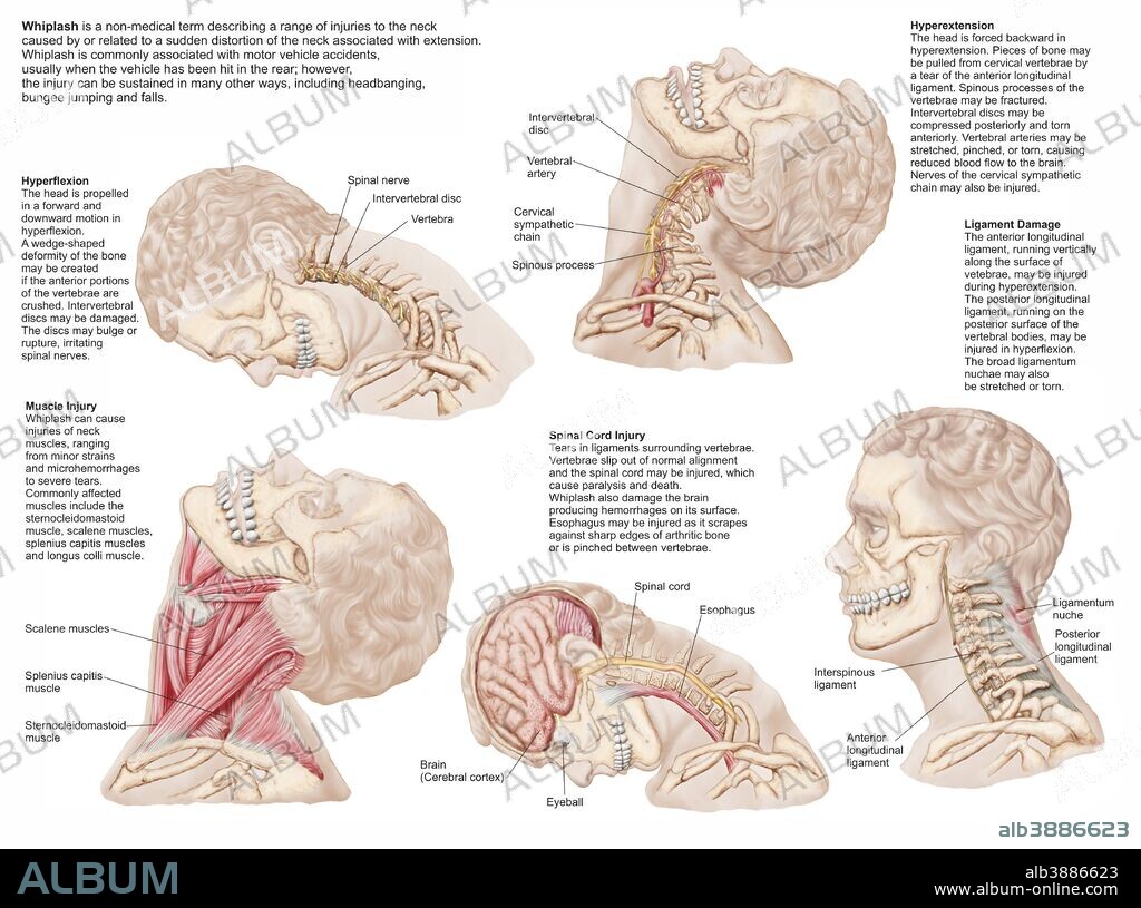 Medical chart showing the range of injuries to the human neck caused by whiplash.