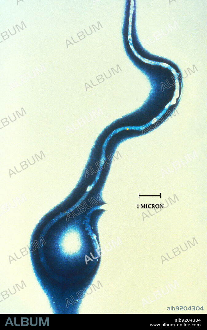 Borrelia burgdorferi is a bacterial species of the spirochete class of the genus Borrelia. B. burgdorferi exists in North America and Europe and is the only causative agent of Lyme disease in the United States. Borrelia species are considered diderm (double-membrane) bacteria rather than Gram-positive or negative. Lyme disease is a zoonotic, vector-borne disease transmitted by the Ixodes tick (also the vector for Babesia). The infected nymphal tick transmits B. burgdorferi via its saliva to the human during its blood meal.