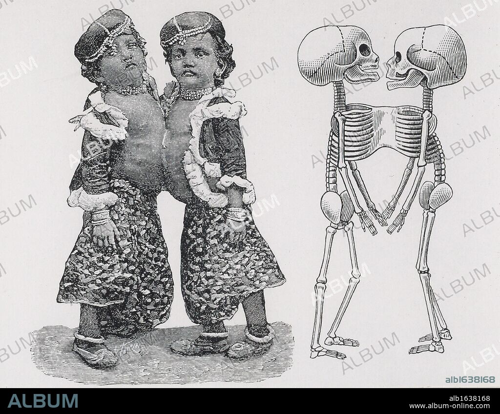 Siamese or Conjoined twins Radica - Doodica, also known as the Orissa sisters, who were joined at the chest (xiphopagus twins). Born in India in 1889, in 1893 they were purchased from their parents by the showman Captain Colman. In February 1902 they were separated as Doodica was suffering from Tuberculosis. Radica survived the operation but died from Tuberculosis the following year. The operation was performed by the French surgeon Eugene Louis Doyen (1859 - 1916). Engraving of the children clothed, and how they were attached. Engraving from "Anomalies and Curiosities of Medicine" by George M Gould and Walter L Pyle (Philadelphia, 1900).