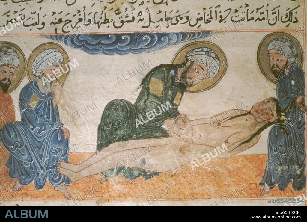 Medizin / Geburt / Kaiserschnitt (Sectio caesarea). /-Ausführung einer Schnittentbindung.-/ Miniatur, persisch, Täbris, Zeit der Ilkhane, 1307. Illustration zu der Chronik "Kitab al-Athar albaqiyah an alqurun alchaliya" (Buch der Hinterlassenschaften früherer Jahrhunderte) des persischen Gelehrte...