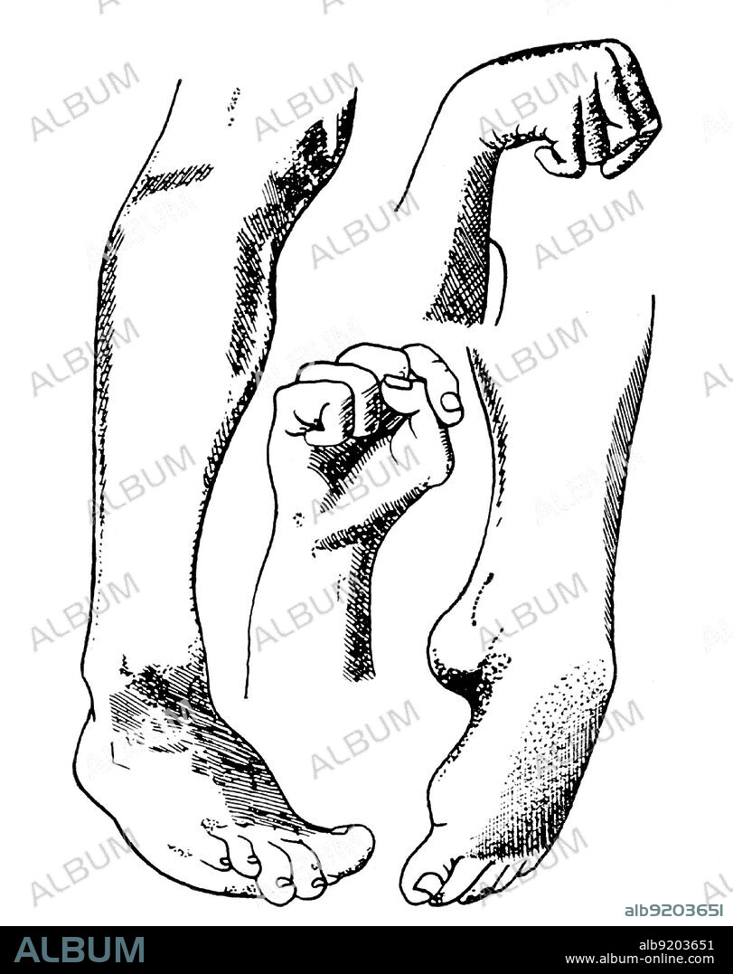 Illustration showing the convulsive symptoms of ergot poisoning. Claviceps purpurea (rye ergot fungus) grows on rye and related plants, and produces alkaloids that can cause ergotism in humans and other mammals who consume grains contaminated with its fruiting structure. Illustration by T.O. Heusinger, 1856.