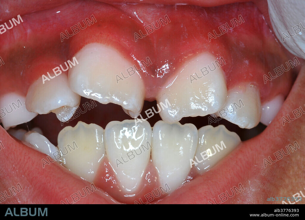 Dens in Dente Malformation of teeth #s 7, 9, and 10 (maxillary right and left lateral incisors, and maxillary left central incisor). Dens in Dente ( tooth within a tooth ), also known as Dens invaginatus, is where the outer surface of the tooth folds inward. Image before restorative procedures.