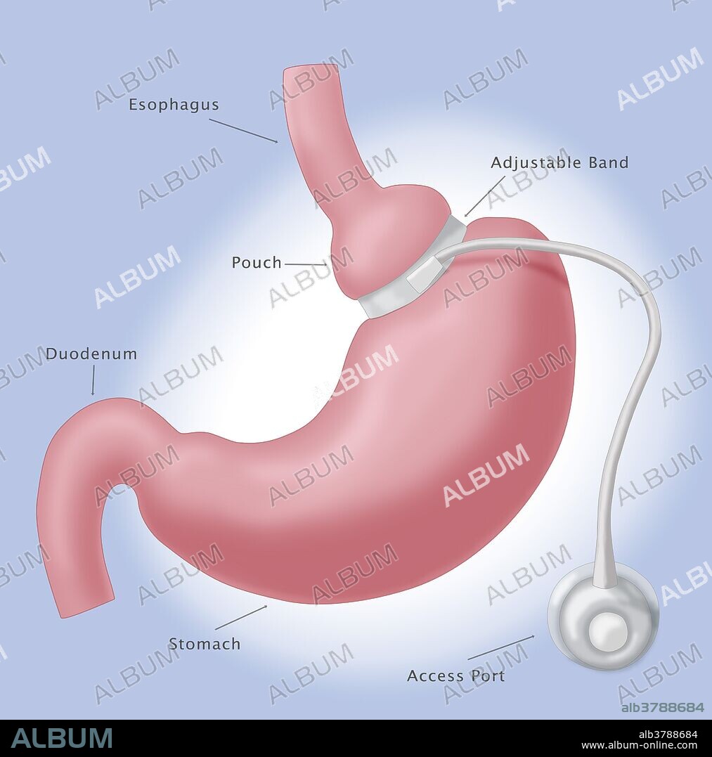 Illustration of a laparoscopic adjustable gastric band, commonly called a lap-band. This is an inflatable silicone device placed around the top portion of the stomach to treat obesity.
