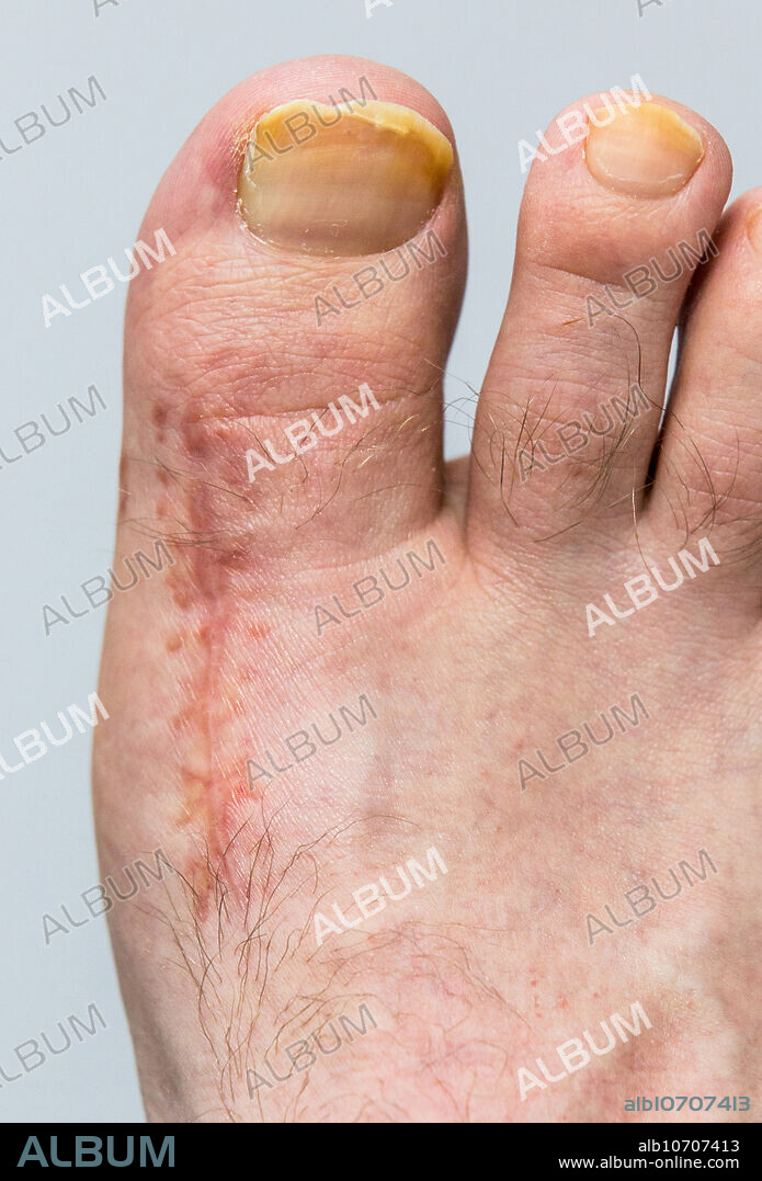 Foot 10 Weeks Post-Arthrodesis Op.