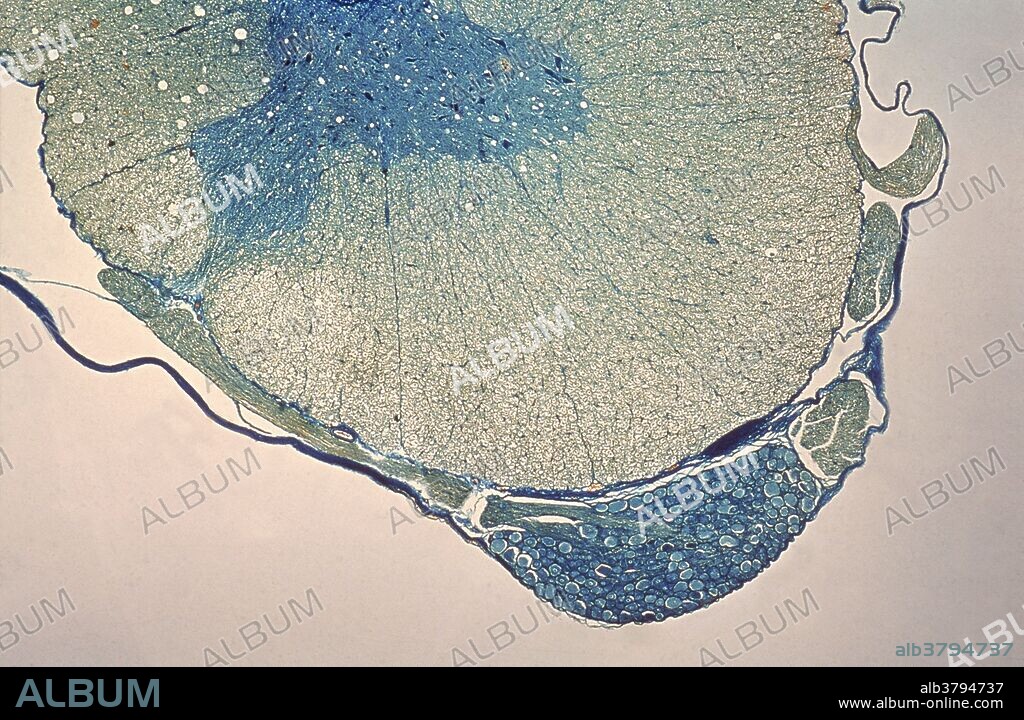 Spinal ganglion; ganglion on the posterior nerve root of spinal cord as it passes through the intervertebral foramina. Ganglia are discrete aggregations of neurons outside the central nervous system.