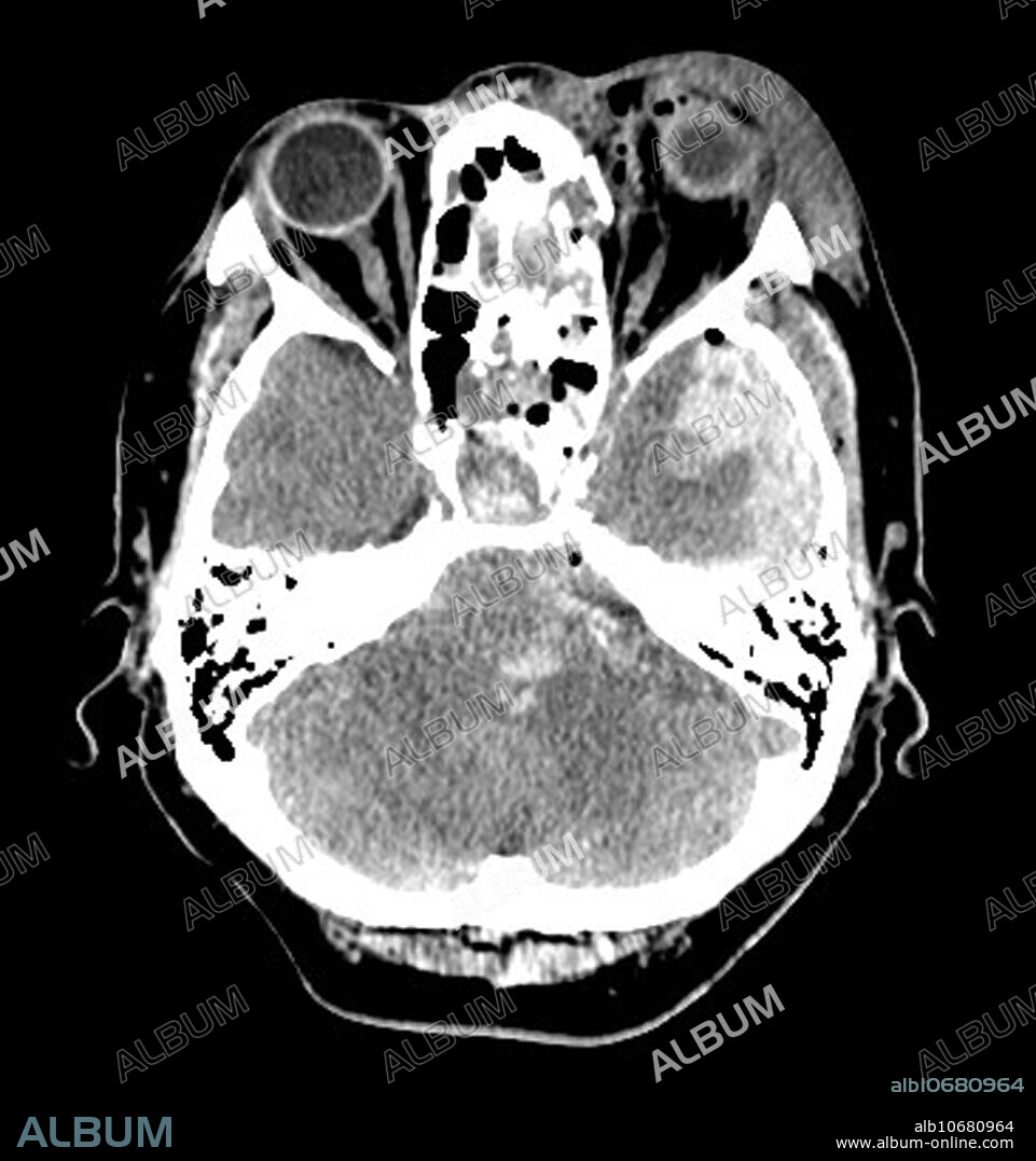 Extensive Traumatic Brain Injury CT