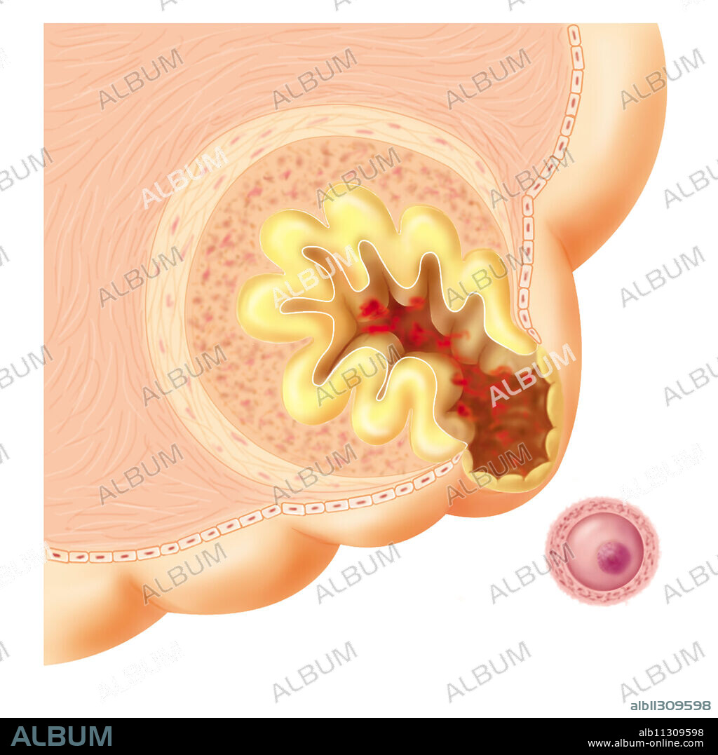 Rupture of the ovarian wall and release of the ovum (ovulation) that was in the Graafian follicle.