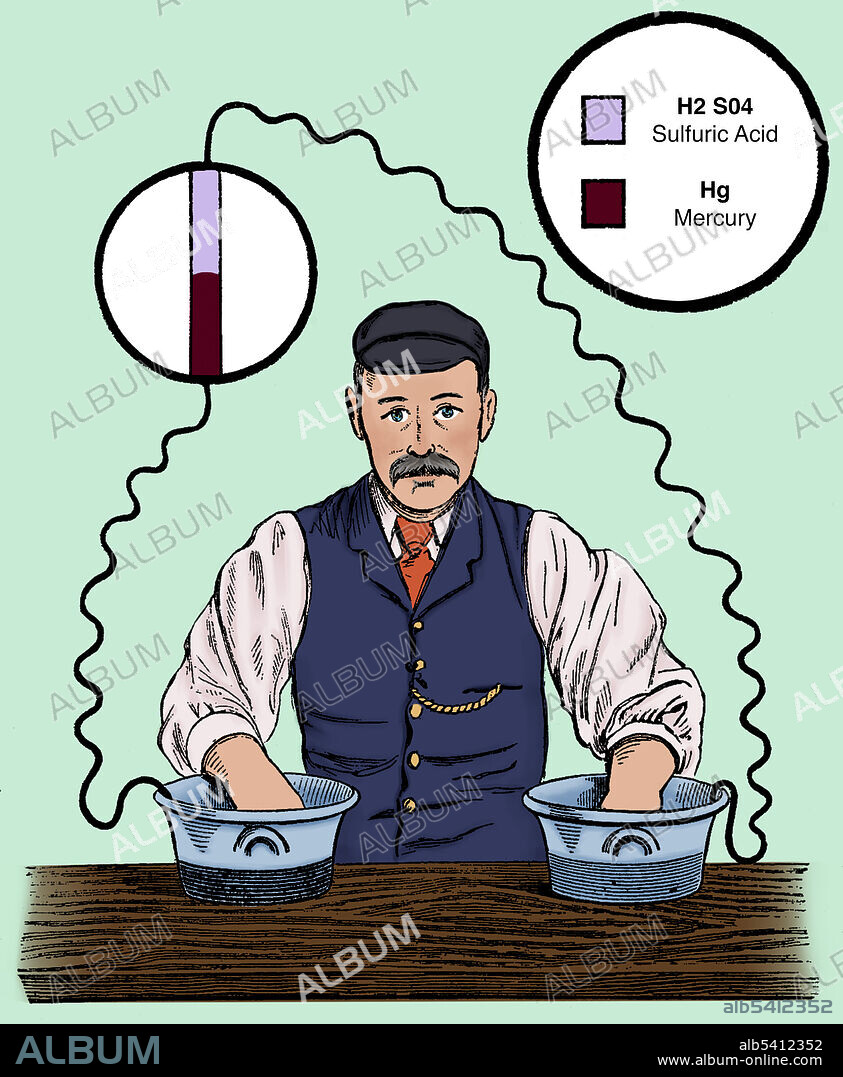 Plate from Augustus D. Waller, Introductory address on the electromotive properties of the human heart. Augustus Desiré Waller (July 18, 1856 - March 11, 1922) was a British physiologist. In 1887 he used a capillary electrometer to record the first human electrocardiogram. He created the first practical ECG machine with surface electrodes. He lectured on it in Europe and America, often using his dog Jimmy in his ECG demonstrations.
