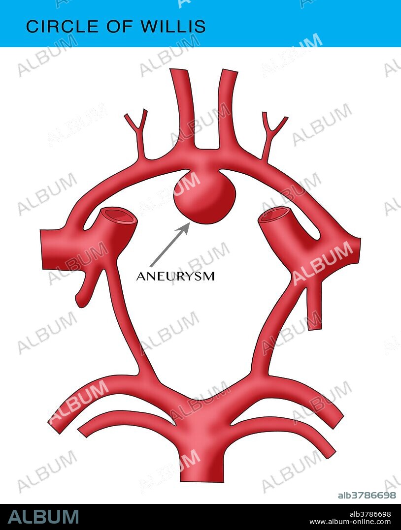 Aneurysm in the Circle of Willis. The circle of Willis (also called Willis' circle, loop of Willis, cerebral arterial circle, and Willis polygon) is a circulatory anastomosis that supplies blood to the brain and surrounding structures. It is named after Thomas Willis (1621-1675), an English physician.