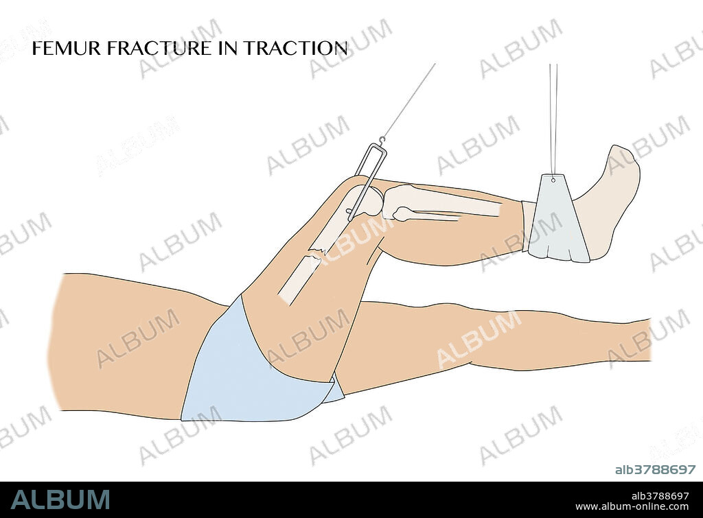 Illustration of a broken femur in traction.
