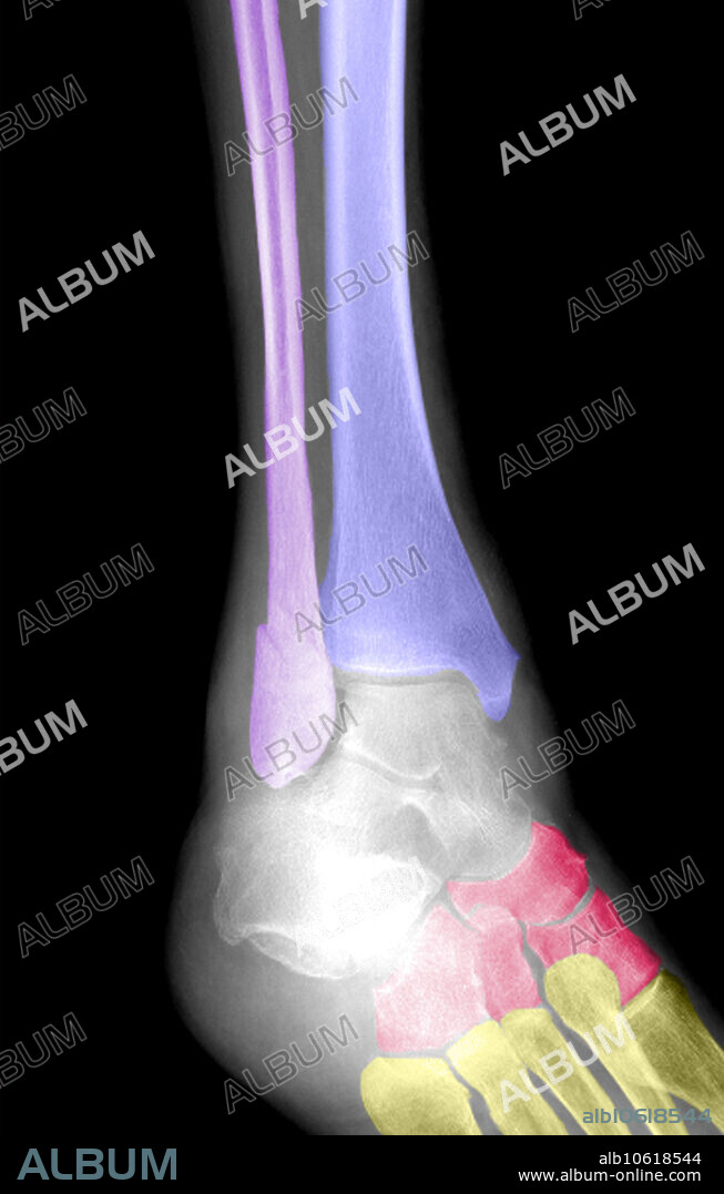 colour-enhanced x-ray of an ankle fracture, with an oblique oriented fracture of the distal fibula (purple) and associated soft tissue swelling, secondary to the injury.