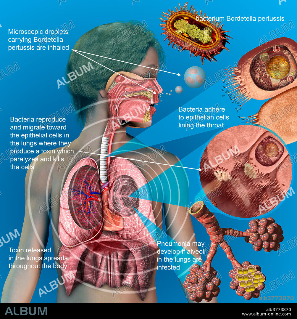 Whooping Cough (Pertussis) - Album alb3773870