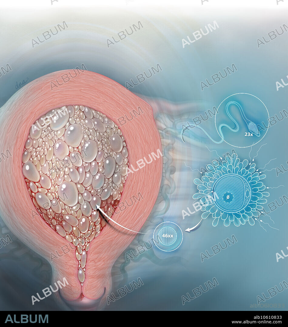 Artistic interpretation of complete molar pregnancy. Overlay showing fertilization of egg containing no nuclear material resulting in trophoblastic proliferation (cytotrophoblast and syncytiotrophoblast).