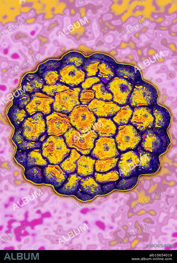 HPV (Human Papilloma Virus or Papillomavirus). The papillomavirus is in the papovaviridae group. HPV causes warts, acuminate condylomas, and respiratory papillomatoses. Certain genotypes of this virus can cause cervical cancer. Viral diameter approximately 45 - 55nm. Viral magnification 2,000,000x at 10cm and image colorization with HDRI treatments on a Transmission Electron Micrograph view (TEM).