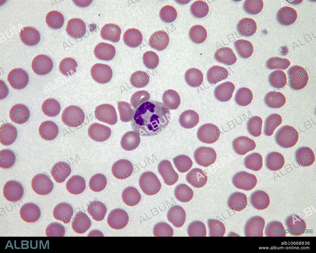 Pelger-Huet anomaly is a benign dominantly inherited defect of terminal neutrophil differentiation secondary to mutations in the lamin B receptor (LBR) gene. Some leukocytes appear as dumbbell-shaped bilobed nuclei (as shown here). Light micrograph, Wright-Giemsa stain. Magnification: 100x.