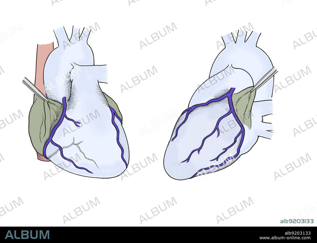 Anatomical illustration of the arteries of the heart, showing (on anterior) right coronary artery, acute marginal branch, and (on posterior) left anterior descending artery, obtuse marginal, left circumflex artery, circumflex posterior descending artery, and posterior lateral branch.