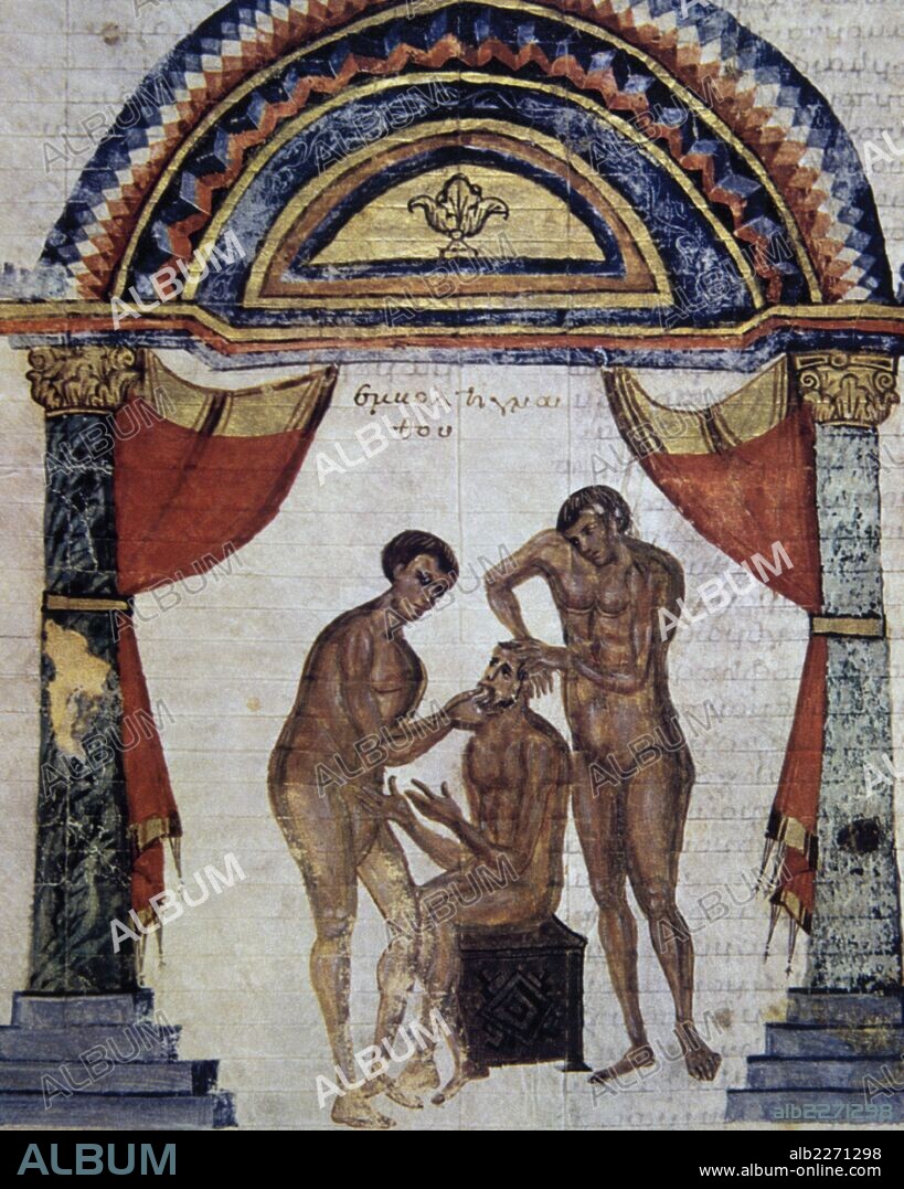 Reduction of a dislocated mandible by a Greek surgeon, from the Commentary with illustrations of Apollonius of Kitum (1st century BC) on Hippocrates, found in a 9th century Greek surgical manuscript.  Laurentian Library, Florence, Italy.