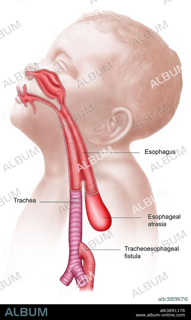 Anatomy of a tracheoesophageal fistula.