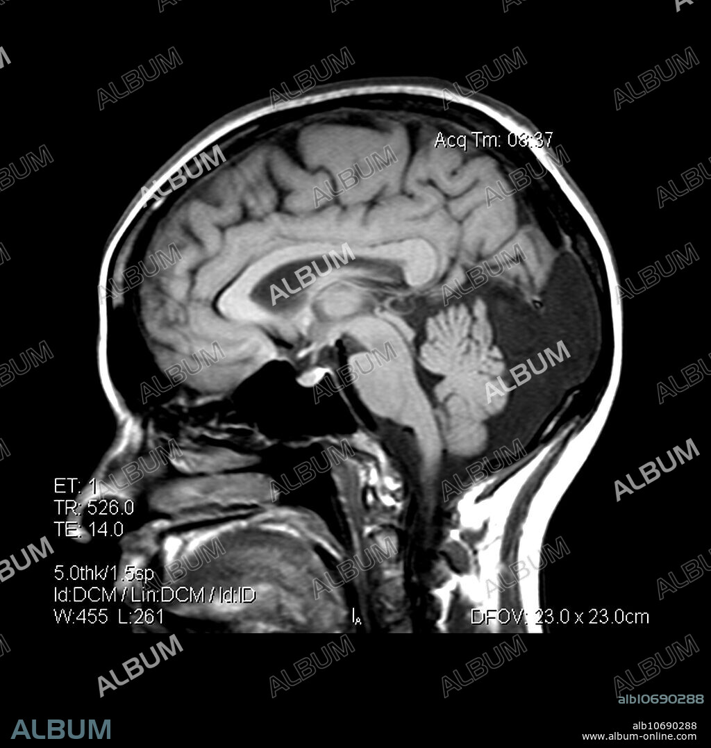 This sagittal (from the side) MRI image of the brain shows a normal variant, referred to as a mega cisterna magna. This is to be differentiated from a dandy-walker variant and retrocerebellar arachnoid cyst.