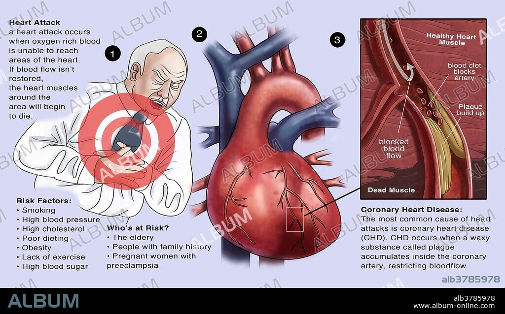 An infographic on heart attacks. A heart attack occurs when oxygen rich blood is unable to reach areas of the heart. If blood flow isn't restored, the heart muscles around the area will begin to die. At left is a diagram depicting coronary heart disease, the most common cause of heart attacks. CHD occurs when a waxy substance called plague accumulates inside the coronary artery, restricting blood flow.