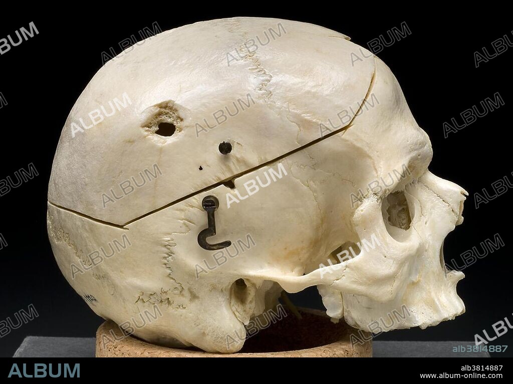 Male skull showing bullet exit wound on parietal bone,1950s. The term ballistic trauma refers to a form of physical trauma sustained from the discharge of arms or munitions. The most common forms of ballistic trauma stem from firearms used in armed conflicts, civilian sporting and recreational pursuits and criminal activity. Trauma a body wound or shock produced by sudden physical injury, as from violence or accident.