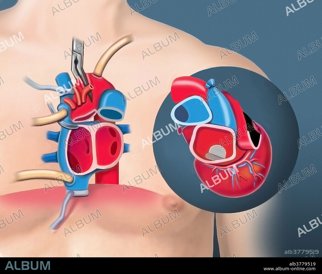Medical illustration of a patient with heart removed and inset of a donor heart ready for placement.