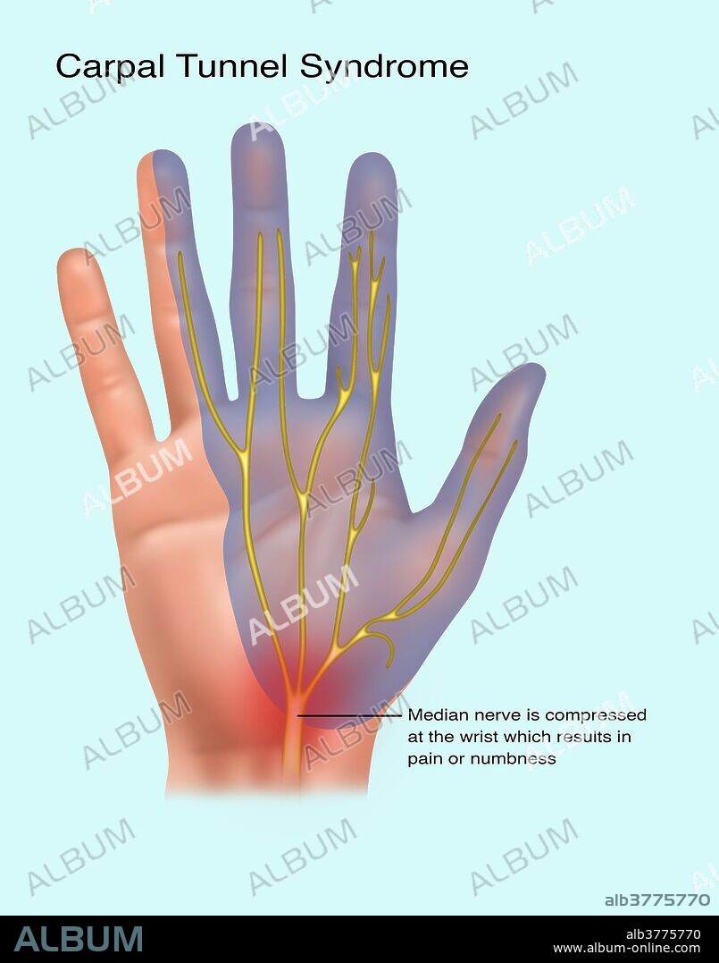 Illustration depicting carpal tunnel syndrome. Carpal tunnel happens when the median nerve is compressed at the wrist, and results in pain or numbness.