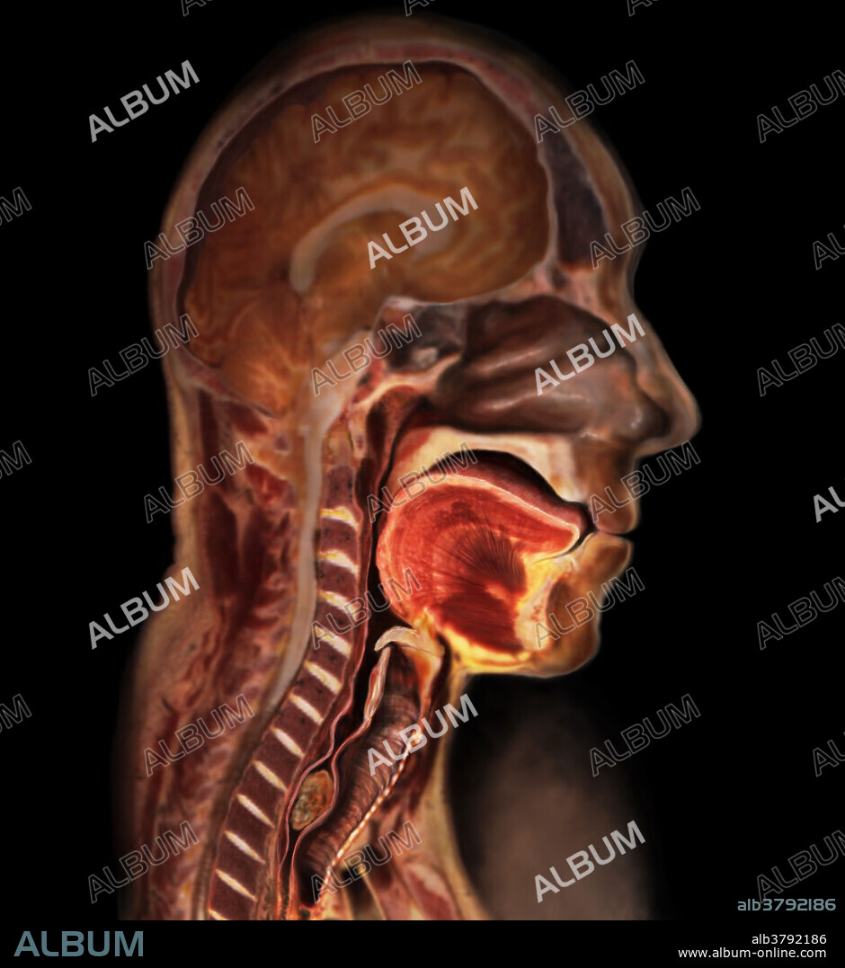 Structures involved in the action of swallowing. A bolus, a soft mass of chewed food, is visible in the esophagus and the epiglottis is bent to cover the windpipe to allow the passage of the bolus. Swallowing, or deglutition, is a complicated process involving over twenty-two muscle groups and the coordination of the tongue, soft palate, pharynx, and esophagus. The first stage is a voluntary action in which the tongue presses against the roof of the mouth and contracts to pass the food to the oropharynx. The second stage, an involuntary action, involves the uplifting of the larynx to allow the epiglottis to cover the trachea while peristaltic contractions move food down the pharynx and esophagus.