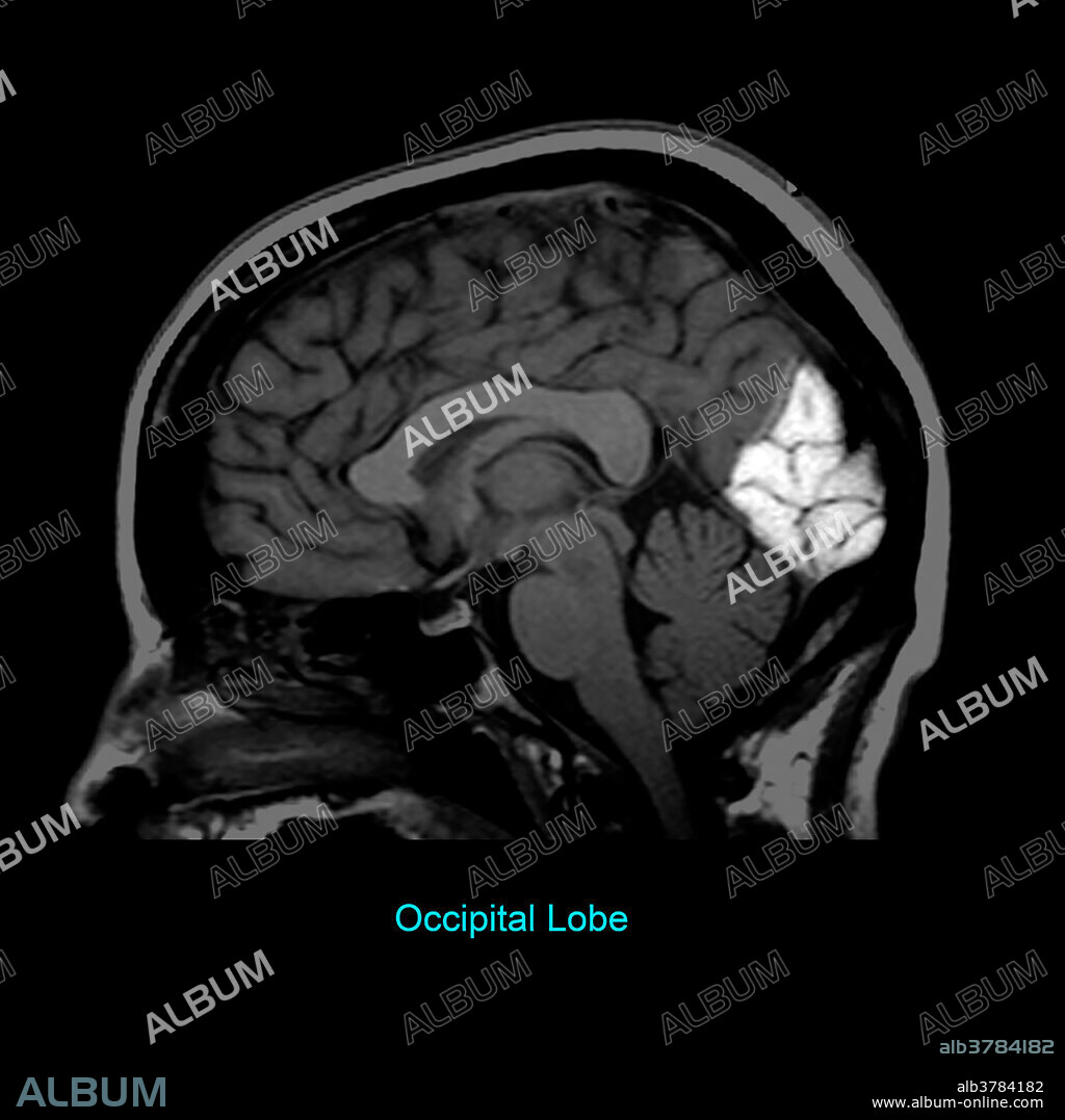 This T1 weighted sagittal (from the side) image of the brain highlights the occipital lobe. This is where the function of vision resides.