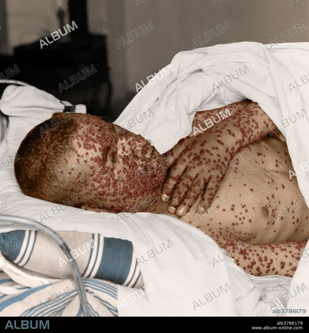 Color-enhanced photograph of an unidentified smallpox victim. Smallpox has now been eradicated, but it was a serious, contagious, and sometimes fatal infectious disease with no specific treatment, the only prevention being vaccination. The name smallpox is derived from the Latin word for "spotted" and refers to the raised bumps that appear on the face and body of an infected person.
