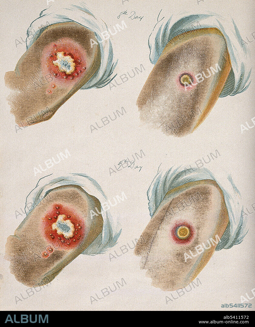 Smallpox and Cowpox Pustules, Days 8 and 9, 1896