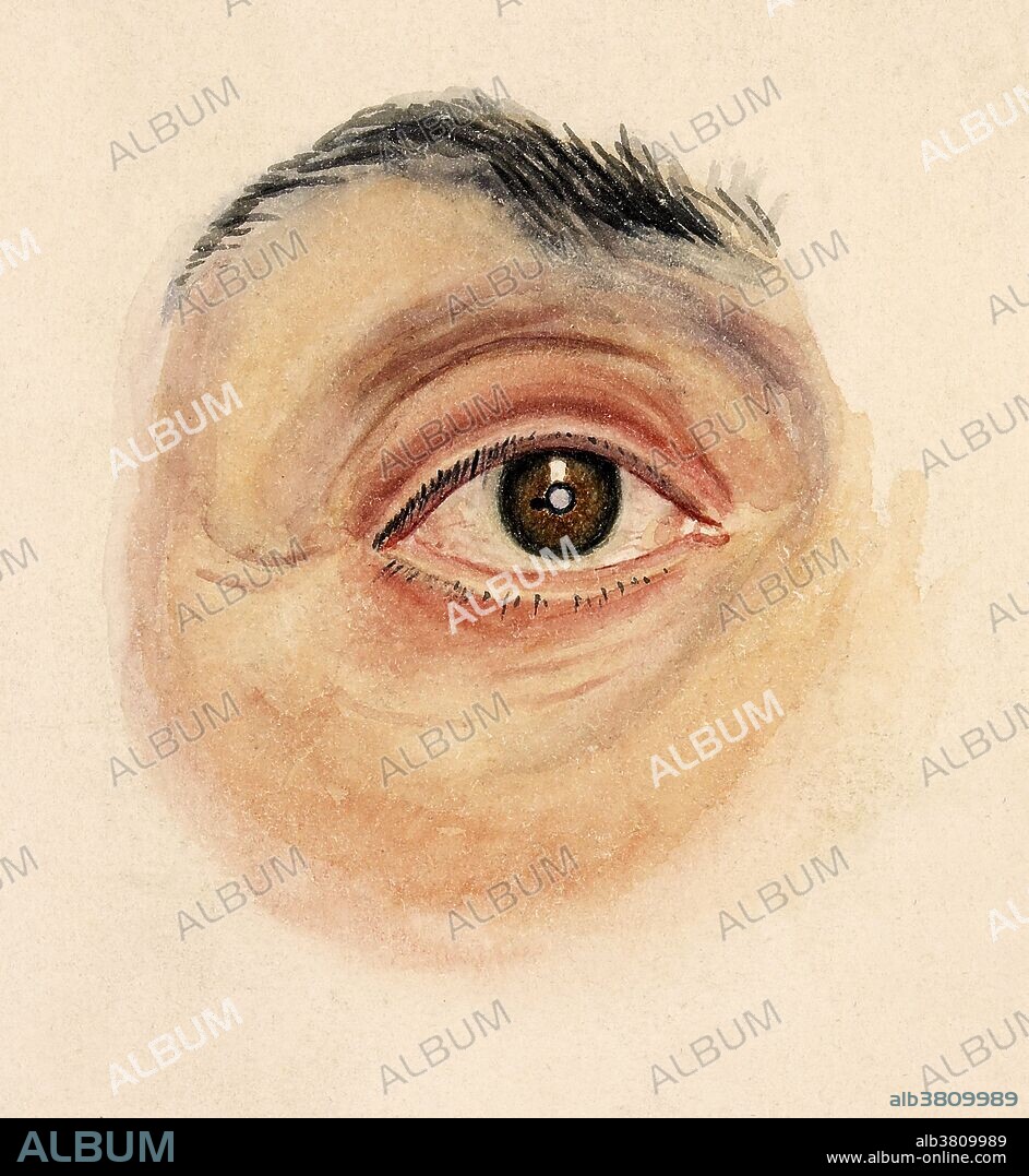 Melanoma of the iris. Historical watercolor drawing of the eye of a man aged 58, showing a small pigmented (black) nodule protruding from the iris near the pupillary margin. Microscopically no sarcomatous elements were found, the nodule consisting entirely of pigment cells. It was therefore determined likely a melanoma. Drawn in June 1895 by Leonard Mark.