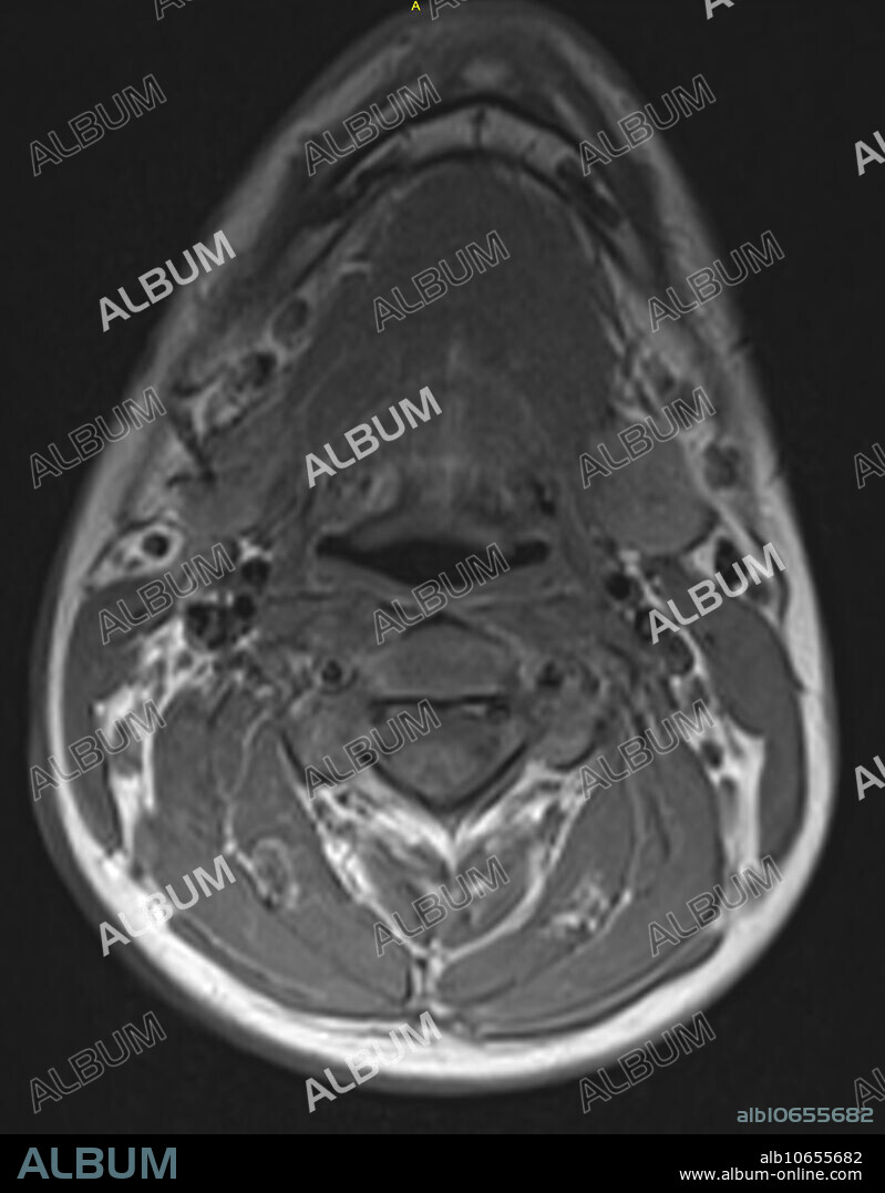 Normal T1 weighted axial MRI showing the neck and cervical spine in a 16 year old male at the level of C3.