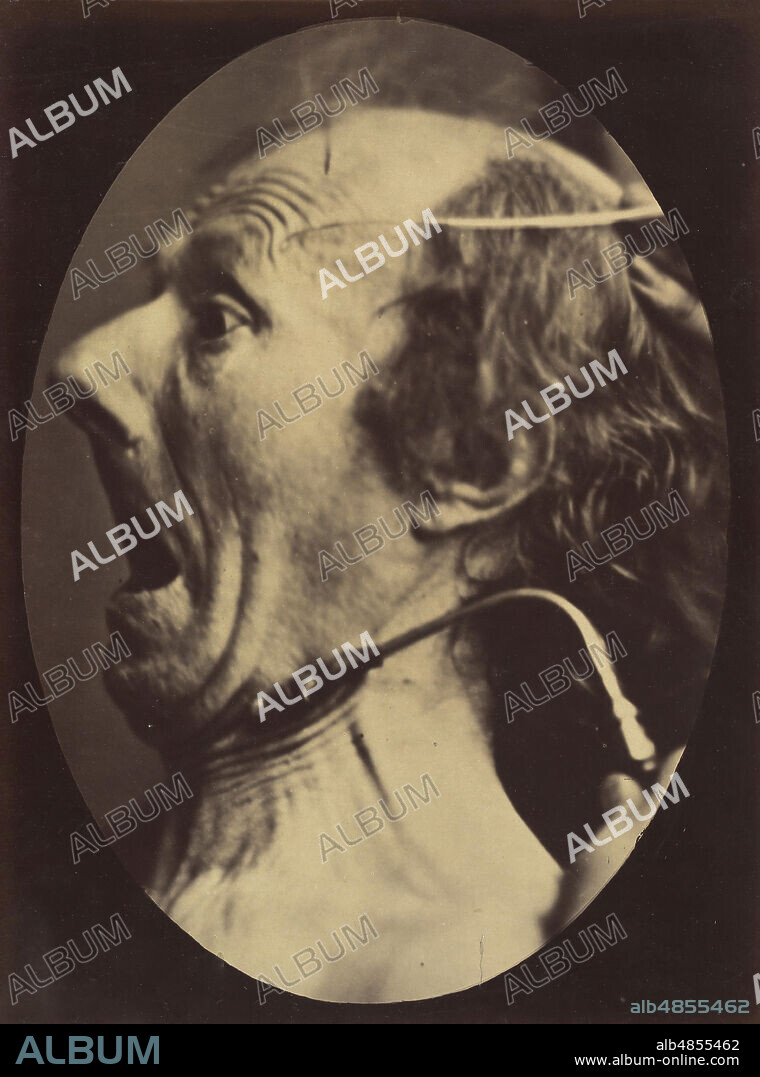 DUCHENNE DE BOULOGNE and ADRIEN ALBAN TOURNACHON. Figure 63: Expression of terror, 1854-56, printed 1862.