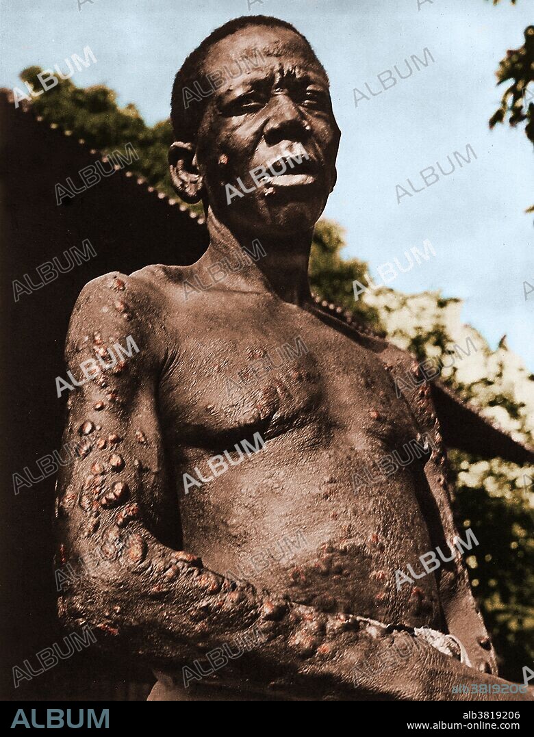 Man with leprosy (Hansen's disease). Mycobacterium leprae is the causative agent of leprosy. It is chronic disease, and progressive if left untreated. It is a disease of the peripheral nerves, and upper respiratory tract. The most prominent symptom is skin lesions. Contrary to belief, leprosy is not highly contagious.